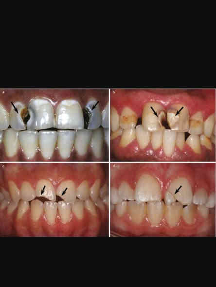 السلام عليكم تعلن عيادات جامعة بابل / كلية طب الاسنان 
إستقبال الحالات التالية  (مجانا) فقط سعر الباص  :
1_قلع الاسنان والجذور التالفه.
2-حشوات دائمية ضوئية وحشوات جذور.
3-تعويض الاسنان المفقودة بطقم كلي 
4-تنظيف الاسنان وازالة التكلسات.
5- معالجة اسنان الاطفال(قلع الاسنان اللبنية/حشوات/تنظيف/وقاية الاسنان من التسوس بإستخدام الفلورايد).
6_  تقويم اسنان متحرك
7_ مشاكل في الفك الصدغي وتقرحات في الفم واللسان 
 للحجز والاستفسار تواصل على الخاص 
او واتساب على الرقم📞 :-  ***********
العنوان🗺 : عيادات طب الاسنان_ حي الاسكان_ قرب الكراج الموحد
