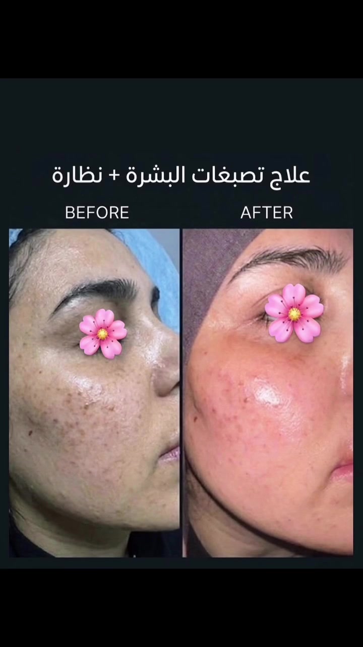 المركز السوري الطبي 
😍😍😍 😍😍 💉🥼🩵 
كافة خدمات التجميل متوفرة بمركزنا ( للنساء والرجال )
وتحت أيادي أطباء اختصاص
متواجدين كل أيام الأسبوع 
المعاينة مجانا

العلاج يتم على جلسات وحسب الحالة 
يتم تحديدها من قبل الطبيبة 
يتوفر علاج 
_الكلف والتصبغات العميقة وحروق الشمس 
_حب الشباب وآثار الحبوب والنظارة 
بهتان البشرة والجفاف

الدكتورة اريج هائل الحيدري ❤️❤️
#فلر #مدينة_الصدر #المحمودية
#المركز_السوري_الطبي
العنوان المحمودية تقاطع العزاب(المجمع) قرب مقر الفوج الثاني سابقاََ
للحجز والاستفسار مراسلة الصفحة أو الاتصال على الأرقام التالية 📱*********** ***********
