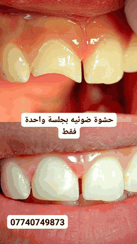 حشوة ضوئية بلون السن وبجلسه واحدة فقط
المسيب مقابل عمارة النسر 
***********
***********
