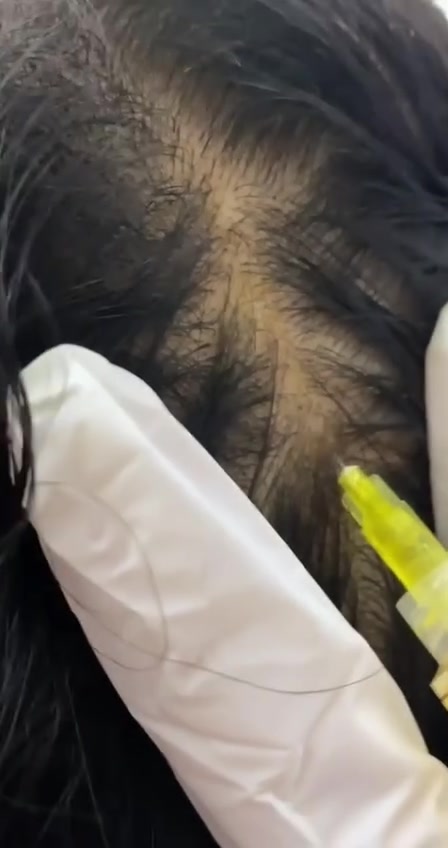 ✨ DQ Hair+ الفرنسي ✨
إذا تعانين من تساقط الشعر أو الفراغات، فـ DQ Hair+ يعد من كوكتيلات الميزوثيرابي المخصصة لدعم صحة الشعر، إذ يحتوي على مزيج من فيتامينات B والمعادن المغذية التي تساعد على تنشيط البصيلات وتحسين الدورة الدموية في فروة الرأس، مما يساهم في تقليل التساقط وتحفيز نمو شعر أقوى وأكثر كثافة.

💉 يُستخدم بالميزوثيرابي أو مع الديرما بن.
🌱 مناسب للرجال والنساء.
📈 يساعد على تحسين مظهر وكثافة الشعر تدريجياً مع الالتزام بالجلسات الموصى بها.

شعر صحي يبدأ ببصيلات قوية. ✨�
(مركز اريا سنتر )
الكاظميه/ الطي/ قرب ماكس كيك
للتواصل ***********
