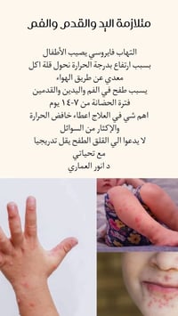 متلازمة اليد والقدم والفم • مرض الأطفال • صحة الطفل • طب أطفال • طبيب ...