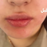 فلر شفايف • مكس نضارة • طبيعي