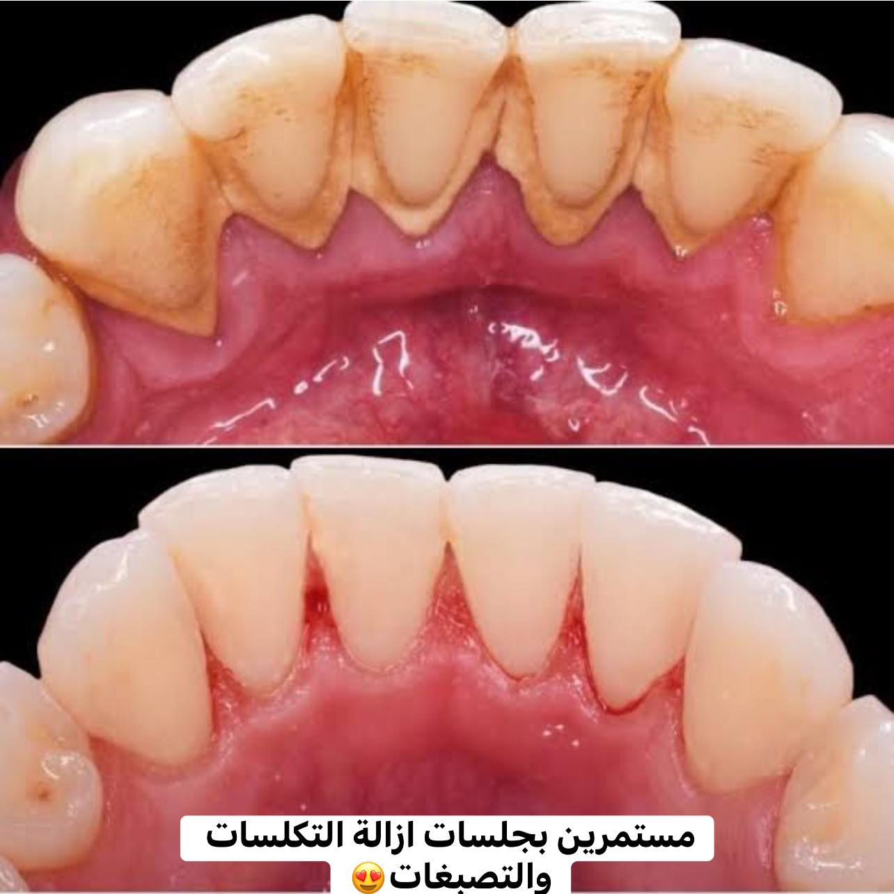 حتى أصعب الأسنان متصعب علينا ✨🦷
شغلنا مو بس علاج… شغلنا دقة ونتيجة تخلّي ابتسامتك غير 💙

ومن شغلنا لهل أسبوع 👇
✔️ حشوات أمامية تجميلية
✔️ حشوات جذور للأسنان الخلفية ويا إعادة بناء السن
✔️ تغليفات زاركون وإيماكس
✔️ تنظيف وإزالة تصبغات

وبما إن عروض الشهر اللي فات عجبتكم كلش ❤️

💥 رجعنالكم بعرض أقوى هالشهر 💥

🎊 أول حجوزات ليومي الثلاثاء والأربعاء🆎:
✨  الهم جلسة تنظيف  وتلميع مجانية

* بالإضافة عروض حلوة ومميزة داخل العيادة على باقي الخدمات

⏱️ العرض محدود وعلى أول حجوزات بس!

📞 للحجز: ***********
او ع الدايركت 
🕓 من 4 العصر للـ 9 مساءً

💙 غايتنا رضاكم وثقتكم
ويا عيادة الجمال… ابتسامتكم تصير أحلى 😍✨
