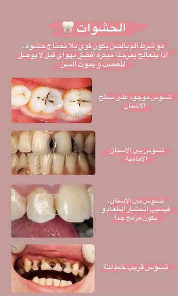 السلام عليكم
اي شخص عنده بقايا جذر او سن منتهي ويريد يقلعه
او عنده تسوس ويريد يسوي حشوة 
وكذلك متوفر طقم اسنان جزئي ومتحرك
متوفر في عيادات جامعة ابن سينا-مقابيل بلدية الرشيد او بانزين خانة البياع
علماً العلاج مجاني
 للإستفسار اكثر تواصل ع خاص او تواصل ع رقم ***********
