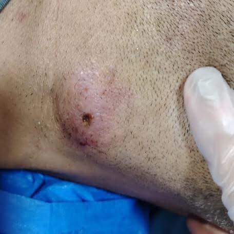 عمليات العيادة اليومية 
عمليات تتم تحت التخدير الموضعي وبخبرة ومهارة عالية وتشمل
🔹 ازالة الاكياس الدهنية 
🔹تنظيف الخراج
🔹تنظيف الناسور
🔹سحب اكياس الثدي  
🔹ازاله الزوائد الجلدية 
🔹قلع الاظافر الملتهبه والتي تنمو تحت الجلد 
🔹تنظيف القدم السكري
🔹تنظيف الجروح وخياطة الجروح بطرق تجميليه
✅هذه العمليات تجرى بشكل يومي داخل عيادتنا اضافة لاجرائنا العمليات الجراحية واعطاء الاستشارات الجراحية 
دمتم سالمين 
—————-
د.ساره محمد صبحي 
اخصائية الجراحة العامة والجراحة الناظورية المتقدمة 
زميلة المجلس العربي للاختصاصات الصحية 
بورد (دكتوراه)في الجراحة العامة وجراحة الجهاز الهضمي 
كركوك-شارع الاطباء-مجمع ناز الطبي 
للحجز الاتصال على الرقم 
***********
