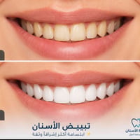 تبييض مجاني • عيادة أسنان • الحريه الاولى