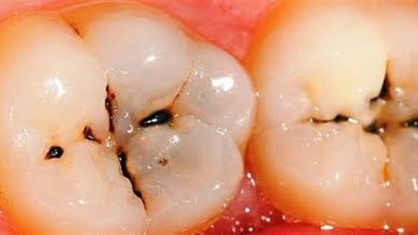 عيادات الكفيل تستقبل الحالات الاتيه:
_تنظيف اسنان من التكلسات (مجانا)
_قلع الاسنان وبقايا الجذور(مجانا)
_تعويض الاسنان
_حشوات ضوئية(مجانا)

علما ان العمل مجاناً 🔴
العنوان: عيادات جامعة الكفيل _ النجف شارع الاسكان _ مجاور مستشفى الزهراء 
للحجز التواصل على الرقم: *********** واتساب
الانستغرام: Q3_2m
