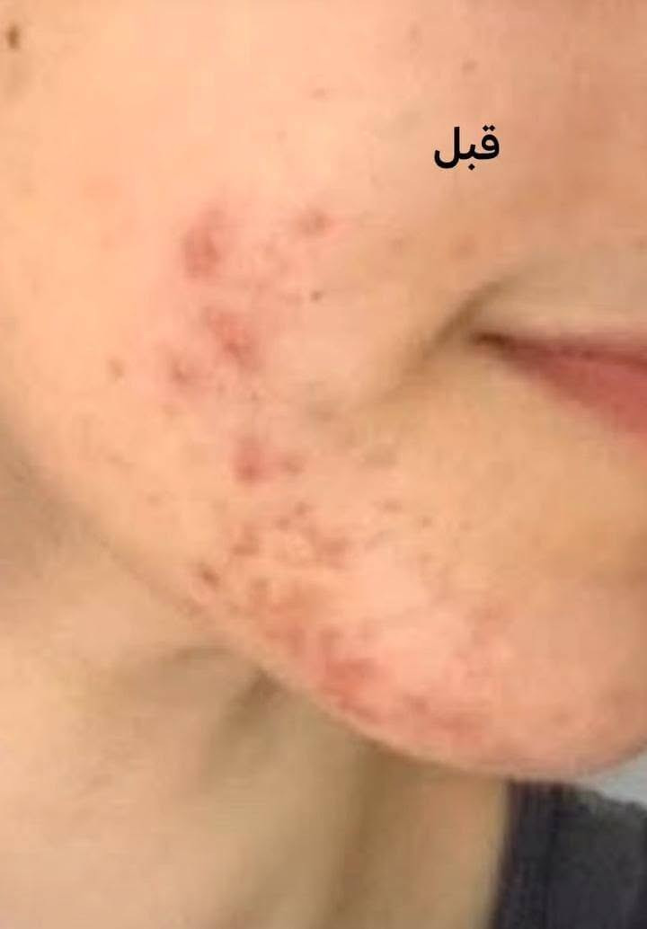هلو بنات جبتلكم بكج كامل سيروم وكريم وصابونه للوجه اذا مو  من اول اسبوع شوفين فرق ترجعيه موجود توصيل بغداد ومحافظات وبسمايه


**إذا كنت صاحب هذا الإعلان وتريد حذفه لأي سبب، رجاءا أرسل رسالة إلى الدعم الفني**