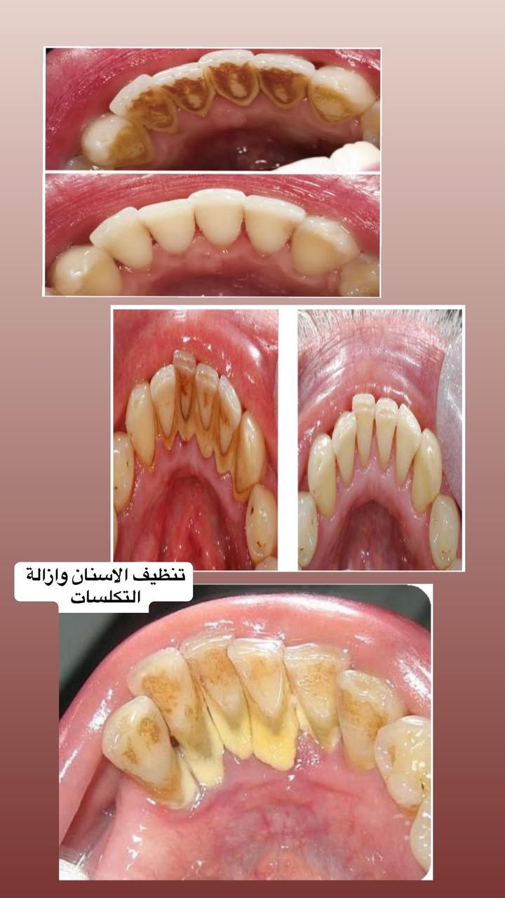 السلام عليكم 

طالبة طب اسنان مرحلة رابعة 
إن شاء الله بداية شهر الثاني تنفتح عيادات الجامعة 
اللي محتاج :
١_تعويض الاسنان المفقودة بطقم جزئي ( متحرك ) 
٢_قلع الاسنان التالفة وبقايا الجذور 
٣_حشوات تجميلية (بيضاء)
٤_تنظيف الأسنان وإزالة التكلسات والتصبغات 

العلاج يتم تحت إشراف اطباء مختصين 

العنوان 
الرمادي / جامعة المعارف / عيادات كلية طب الاسنان / الباب الخلفي 

للحجز واتساب ***********
