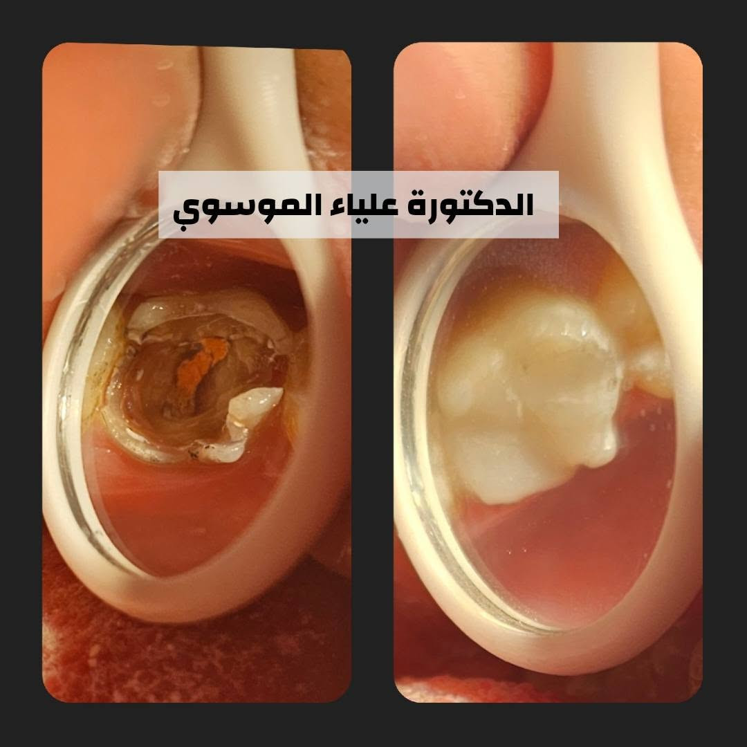 تتواجد الدكتورة علياء الموسوي يوميا من ساعة ٤ إلى ساعة ٩ مساءا في المشتل شارع المطبك للاستفسار ***********
