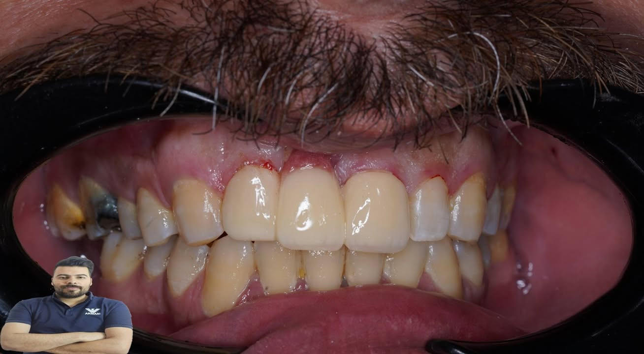 ابتسامة جديدة مراجع يعاني فقدان في سنهة الامامي سوينالة تغليف زاركون بلون مقارب للون الاسنان المجاورة

العنوان / المسيب / شارع البلدية / مقابل دكتور جعفب وفي للاطفال

للحجز والاستفسار
***********
***********
