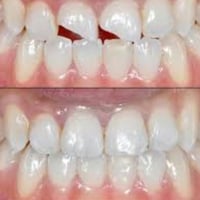 تعويض السن المكسور بحشوه بيضاء  بلون الاسنان الطبيعي للحجز  مراسله الص...