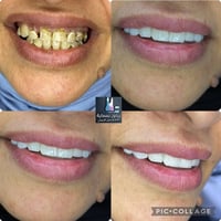 زيركون 7D • بالتقسيط • خصم50%