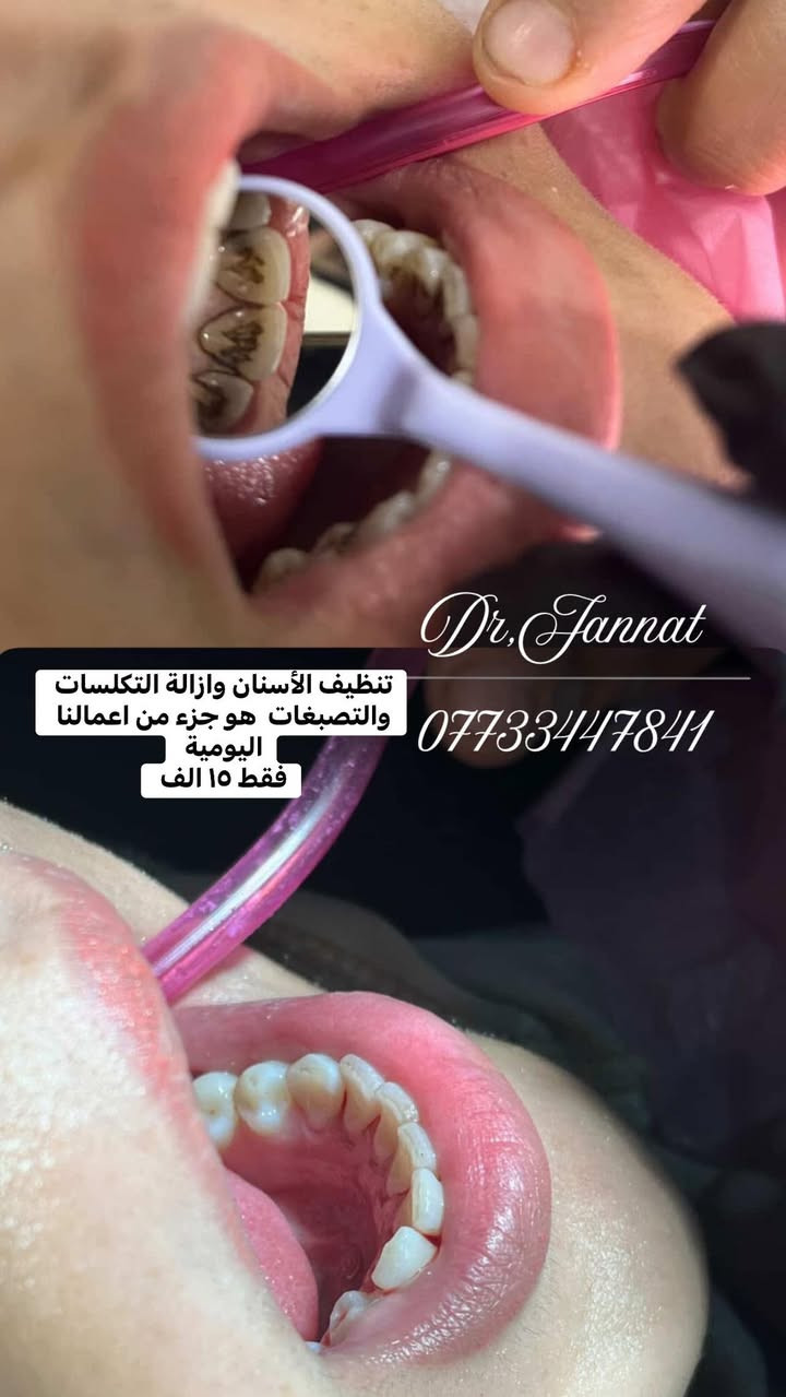 هذا المنشور لكل الي سألونا على عنوان العيادة 
عنوانا هو الفحامة  شارع مركز الشرطة مجاور عيادة الحكيم التمريضية

متوفرة عدنا كل الخدمات : من حشوات  تجميلية 
حشوات جذور 
تغليفات زاركون وايماكس
تقويم
تنظيف وتبييض 
تجميل لاجراحي 

والأسعار  مثل ما وعدناكم كلها راح تكون مناسبة 
وبضمان النتيجة 

كل الي عليكم تراسلونا 
 او تزورونا متواجدين طيلة ايام الأسبوع 
حتى الجمعة 
من ساعة 4-9 مساءً

📍 لكل الي سألونا على عنوان العيادة 🦷✨

عنوانا: الفحامة – شارع مركز الشرطة
مجاور عيادة الحكيم التمريضية 📌

عدنا كل خدمات الأسنان:
🦷 حشوات تجميلية
🦷 حشوات جذور
🦷 تغليفات زاركون و  وايماكس 
🦷 تقويم أسنان
🦷 تنظيف وتبييض
🦷 تجميل غير جراحي

💙 أسعارنا مثل ما وعدناكم… مناسبة وبأعلى دقة وبضمان النتيجة 👌

📩 كل الي عليكم تراسلونا أو تجون تزورونا
احنا متواجدين طيلة أيام الأسبوع حتى يوم الجمعة
⏰ من الساعة 4 إلى 9 مساءً

كادرنا ينتظركم بكل حب 🦷
 ابتسامتكم  ويا عيادة الجمال اكيد راح تكون أجمل  🤍


**إذا كنت صاحب هذا الإعلان وتريد حذفه لأي سبب، رجاءا أرسل رسالة إلى الدعم الفني**
