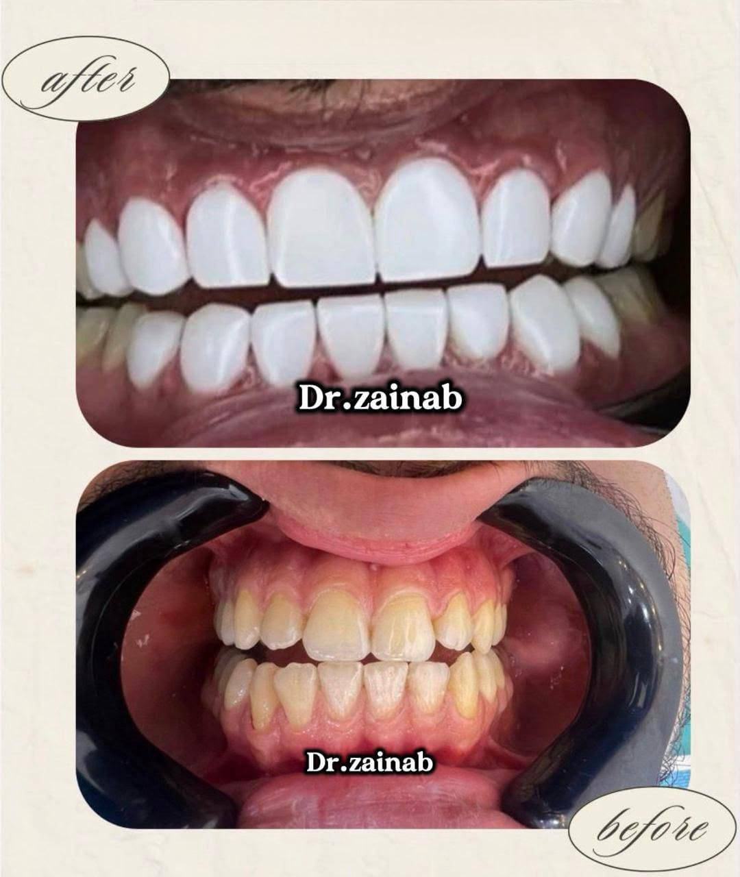 ✨ ابتسامتك تبدأ من هنا ✨

في عيادة الدكتورة سمر أمير لطب وتجميل الأسنان نهتم بصحة أسنانك وجمال ابتسامتك بأحدث التقنيات وعلى أيدي أطباء ذوي خبرة.

🦷 خدماتنا تشمل:
✅ تنظيف وتلميع الأسنان
✅ تبييض الأسنان
✅ الحشوات التجميلية
✅ سحب العصب
✅ تركيبات الأسنان
✅ زراعة الأسنان
✅ هوليوود سمايل
✅ تقويم الأسنان

📍 العنوان: بغداد – مواصلات – شارع الضغط – فوق صيدلية قمر بغداد

📞 للحجز والاستفسار:
***********
***********

🌟 احجز موعدك اليوم... لأن الابتسامة الجميلة تستحق أفضل عناية.
