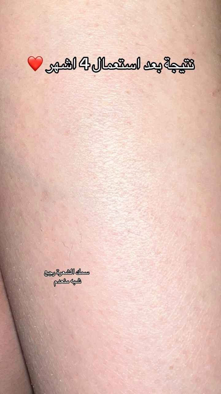 💫 جهاز الليزر المنزلي IPL 💞
ودّعي الشعر الزائد بدون ألم 😍
✨ 500 ألف ومضة ضوئية
✨ مناسب للوجه والجسم والمناطق الحساسة
✨ للنساء والرجال
✨ يساعد على نعومة وتوحيد لون البشرة
🔥 نتائج فعالة من البيت بكل سهولة

> ﹏﹏﹏﹏﹏﹏ 𓍢ִ໋ 🫧 ✧ 🦢 𓍢ִ໋ 🪞 ﹏﹏﹏﹏﹏﹏
> 𓍢ִ໋🌷‌֒ ✧˚ ༘ ⋆｡˚ ☁️
💰 السعر 60 ألف فقط 😱 الرمادي, الأنبار


**إذا كنت صاحب هذا الإعلان وتريد حذفه لأي سبب، رجاءا أرسل رسالة إلى الدعم الفني**