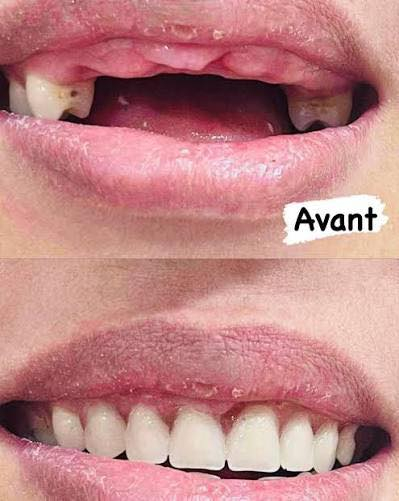 السلام عليكم  
🦷‼️
الدكتور عبدالله قاسم 
استقبل هاي الحالات :-
قلع الاسنان والجذور التالفه 
وتعويض الاسنان المفقودة بطقم جزئي
حشوات تجميلية للاسنان 
وتنظيف الاسنان وازالة التكلسات والتصبغات 
 
‼️علماً العلاج مجاني وباشراف اطباء اختصاص‼️

📍العنوان:- الكرادة_شارع 52_عيادات جامعة اوروك

  *********** 📞واتساب
