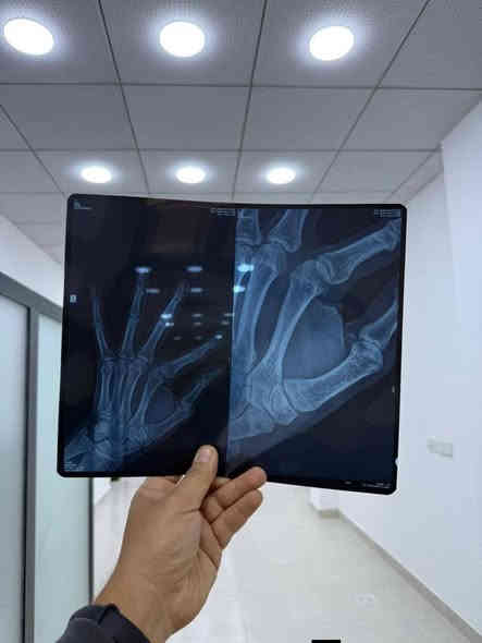 📢 إعــــلان
يعلن مجمع السعدون الطبي عن تواجد
👩‍⚕️ الدكتورة فاطمة رشيد فليح
🦿🦾 أخصائية المفاصل والروماتزم والعلاج الطبي
📍 العنوان: قلعة سكر – شارع الأطباء – مجمع السعدون الطبي
🕒 أيام التواجد: الخميس، الجمعة، السبت من كل أسبوع (عصراً)
🔔 يبدأ الدوام اليوم الجمعة الساعة 3 عصرًا بإذن الله
للحجز والاستفسار:
📞 *********** 
كما يعلن مجمع السعدون الطبي عن تشغيل
 أحدث جهاز للأشعة الرقمية DR
من شركة كيرستريم الأمريكية
للحصول على صور أشعة عالية الدقة وجودة ممتازة.
📍 قلعة سكر – مجمع السعدون الطبي
