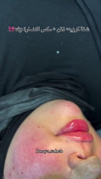 فلر سويسري • فلر شفايف • الديوانية