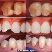 حشوات تجميلية للاسنان ✨ 🔴مجاناً.. مجاناً   حشوات تجميلية ضوئية للاسنان...