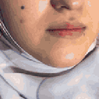 شفه كرزية • تجميل شفايف • المسيب بابل