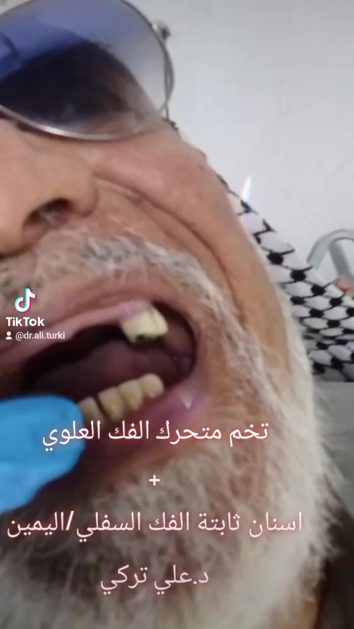 تخم متحرك الفك العلوي 
+
اسنان ثابتة الفك السفلي/ اليمين
د.علي تركي عبادي 
للحجز والاستفسار 
0774 988 9272
