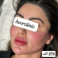التغيير الشامل بالفلر الكوري(اصداغ+وجنات +استدارة+خطوط ضاحكة+ذقن +شفة)...