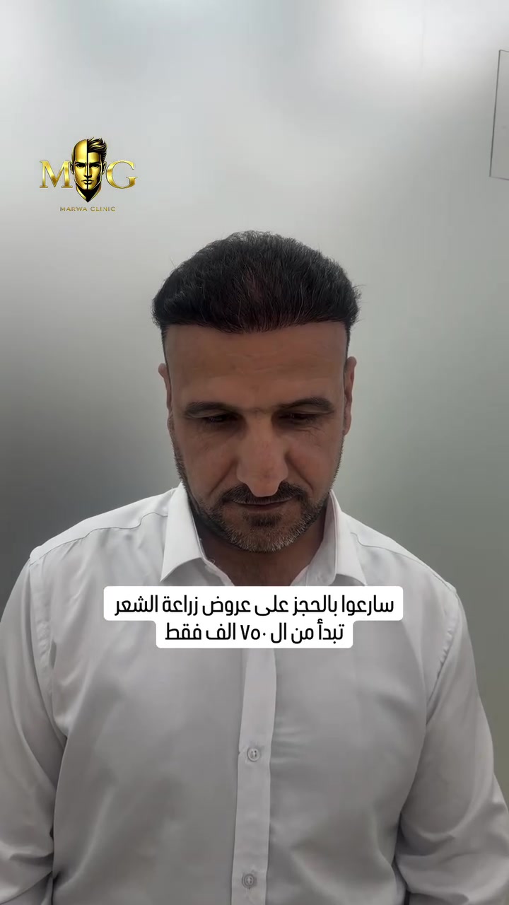 ودّع الفراغات… واسترجع كثافة شعرك بثقة

بأحدث تقنيات زراعة الشعر
نتائج طبيعية ✨
ودقة عالية بكل تفصيل ✅

💰 الأسعار تبدأ من 750 ألف دينار فقط
💳 مع إمكانية التقسيط المريح

شنو يشمل العرض؟
• استشارة وتقييم مجاني
• تصميم خط شعر طبيعي يناسب ملامحك
• تخدير مريح بدون ألم
• عناية ومتابعة بعد الجلسة
• جلسات دعم للشعر بعد الزراعة 🎁

⏳ العرض مستمر لمدة 10 أيام فقط
📌 المقاعد محدودة للحجوزات المبكرة

📍 بغداد – مركز مروة الجنابي لزراعة الشعر
📞 ***********
