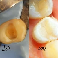 حشوة ضوئية • دائمية • الرمادي الصوفية