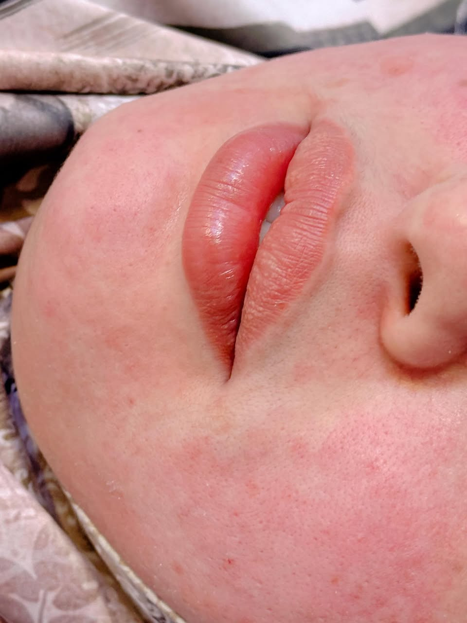 ⁨ الرسمة من بعد ١١ شهر ولا غلطة ❤️‍🔥🫶🏻
📍📍عيادة بيرلي (نبتون)
الحمزة الشرقي جهة شارع الملاحة مقابيل صيدلية نجلاء الشيباني 
واتساب او الاستفسار ***********
#الحمزة_الشرقي #الديوانية #الحمزه_الشرقي #عيادة_بيرلي_نبتون #فلر_شفايف #فلرشفة_فلر_وجنات_فلرخطوط_ضاحكة_فلرذقن_تكساس_تكنيك❤️❤️❤️⁩⁩
