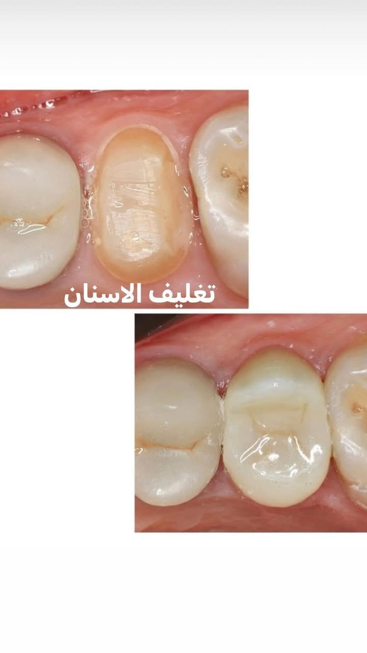 اللي يريد يحجز يتصل او يدز عالخاص 

عيادة طب الاسنان 
تقويم الاسنان ،، زراعة الاسنان ،، حشوات تجميلية
تركيب الاسنان (سيراميك و زارگون)،، حشوات جذور ،، قلع،، حشوات مؤقتة ودائمية ،، تنظيف وتلميع الاسنان ،، تبييض الاسنان بالليزر 
متواجدين طيلة أيام الاسبوع 
للحجز والاستفسار ع الخاص او ع الرقم 
*********** واتساب 
العنوان .. الامين الثانية شارع البنازيخانة يم السوگ 
قریب ع افران السلام واسواق الشارقة مقابل محلات الصبيحاوي
مجمع دكتورة رجاء محمد نصيري
