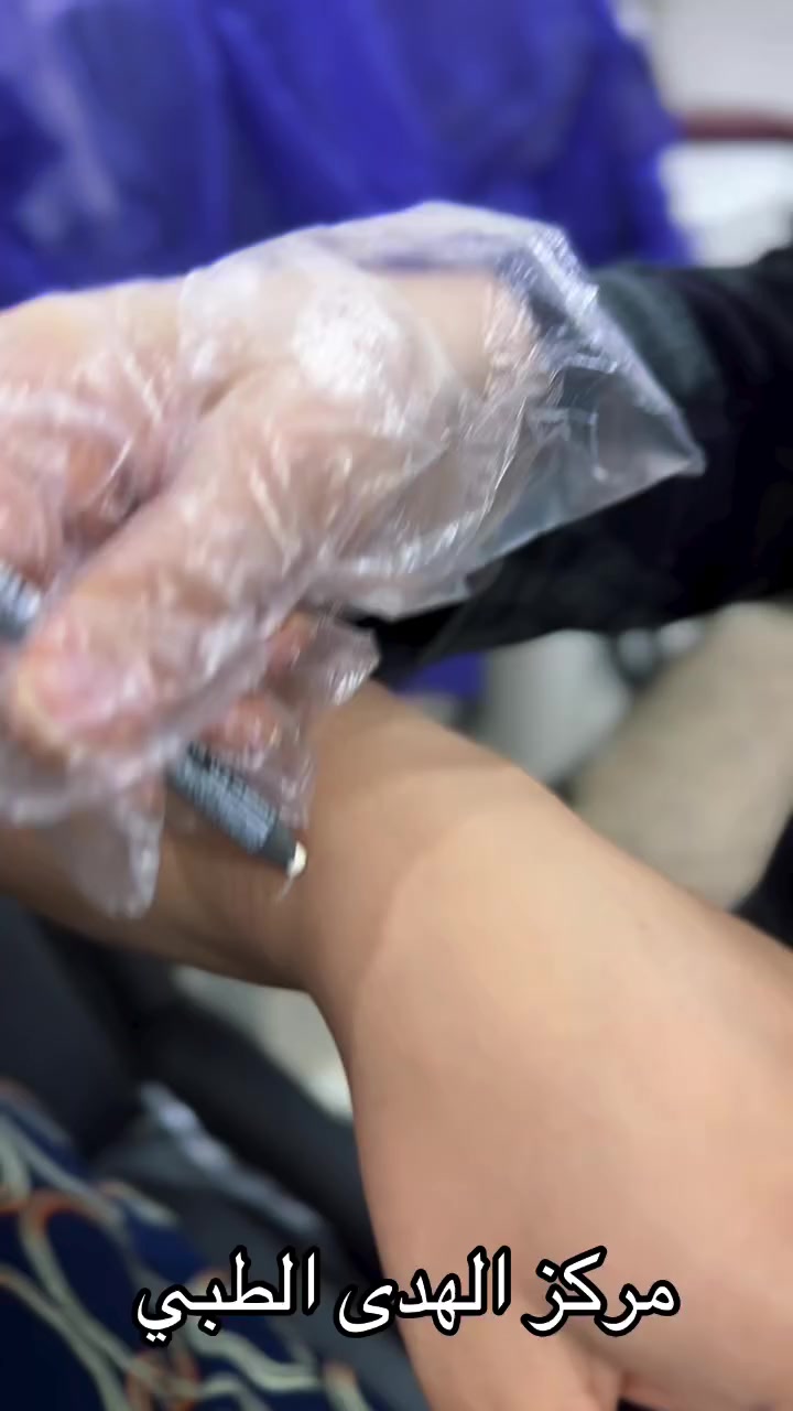 🔹قسم ليزر ازالة الشعر  في مركز الهدى الطبي كادر مختص 👍🏼بإدارة الدكتوره اختصاص  امراض جلدية وتجميل ( الدكتوره هدى علي كاظم )اليكم بالفيديو جلسة ليزر شعر اليدين تقوم تقنية الوميض الضوئي المكثف  على توصيل طاقة حرارية خفيفة و مناسبة للمنطقة المراد ازالة الشعر منها حيث يقوم الشعر بامتصاصها و من ثم تتعطل الخلايا المسؤولة عن نمو الشعر فيختفي الشعر تدريجيا ثم لا يظهر مجددا على مدار الجلسات. مركز الهدى الطبي للجمال عنوان 😍♥️العنوان ميسان سوق الذهب مقابل ميسان شوب  وطارق للعطور


**إذا كنت صاحب هذا الإعلان وتريد حذفه لأي سبب، رجاءا أرسل رسالة إلى الدعم الفني**