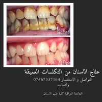 ⬇️⬇️ -علاج الاسنان الامامية بحشوات تجميلية . -علاج اللثة من الالتهابات...