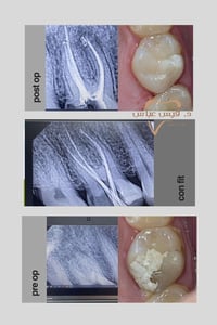 #حشوة_جذر #حشوة_تجميلية   علاج عصب لسن خلفي مع إعادة ترميمه بحشوة ضوئي...