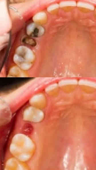 السلام عليكم 
تعاني من ألم ، تسوس ، أو تحتاج تنظيف للأسنان وازالة التكلسات ؟

عيادات جامعة كلكامش تقدّم لك علاج مجاني ويشمل  :

- تنظيف عميق وإزالة التكلسات

- حشوات تجميلية

- قلع الأسنان المتحركة أو الجذور التالفة عند الضرورة

- طقم جزئي متحرك لتعويض الأسنان المفقودة

- تشخيص دقيق وخطة علاج كاملة

✔️ شغل نظيف وآمن
✔️ أدوات معقمة
✔️ متابعة كاملة لحالتك

📍 العنوان: الدورة - حي الصحة - عيادات جامعة كلكامش (مجمع نون والقلم)

للحجز والاستفسار : ***********
راسلوني واتساب او على الخاص  🤍

د. زهراء علاء
