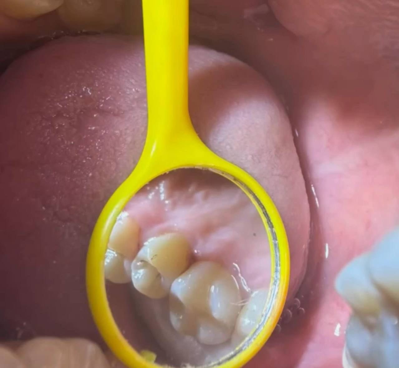 حشوة ضوئية وبجلسة واحدة فقط 🦷
العنوان 
شارع المحكمة 
قرب مختبر حيدر الكرار 
#للاستفسار__والحجز
 عبر صفحة العيادة 
او على الرقم ***********
