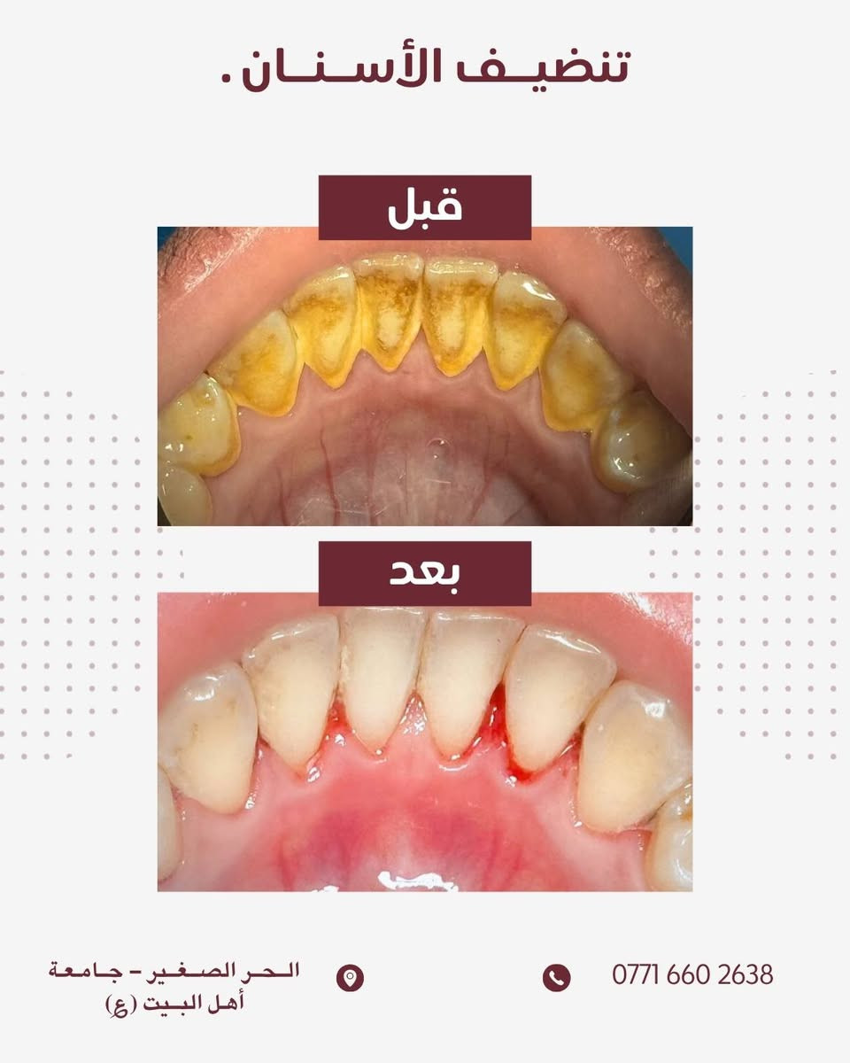 مـجـانـاً 
عمل خيري موافقة الادمن المحترم 
السلام عليكم 

الأسنان بصورة عامة حالها حال اي عضو بجسمك ضروري تعتني بيهم و ترتبهم، الاهمال ب مرور الوقت يكلفك جهد و قيمة مادية 💲 .
واني ب صفتي طالب متدرب ممكن اساعدك نخلص من كل مشاكلك تحت أشراف افضل الكوادر الطبية .
● جميع الحالات المذكورة ادناة مجاناً و جودة عالية ✔️.
● اضافةً علاج جميع حالات الاطفال من ( 6 - 15 ) سنة .
و مشاكل المفصل الفكي او التهابات السان و الثه 

تفاصيل اكثر : اتصال او واتساب 

0771 660 2638 🦷 كربلاء, العراق
