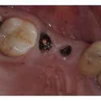 قلع أسنان مجاناً • ضرس العقل • النجف الأشرف