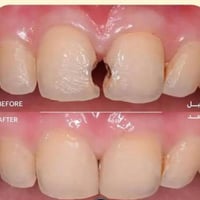اني طبيبة اسنان اشتغل مجاني الي عندة تسوس  بلاسنان الامامية يتواصل ويا...