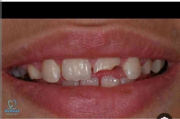 السلام عليكم الي محتاج حشوات مجانيه
مثل هيج حالات اتصال  على ***********
