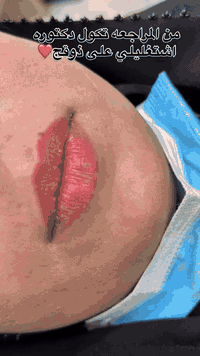 فلر شفة سيسي واحد لجميلتنا ❤️ د.فاطمه هادي  رقم الحجز ٠٧٨٠١٣٧٦٦٦٢