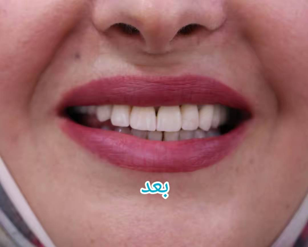 حالة اليوم زراعة الأسنان المفقودة 🦷✨ وترميم الأسنان  واعادتها للشكل الطبيعي 
لمراجعتنا من حي النصر

🔩 تمت الزراعة باستخدام الزرعات الألمانية 🇩🇪
لتعويض الأسنان المفقودة بشكل طبيعي وآمن 😍

✨ خلي ابتسامتك ويانه أحلى
✨ ابتسامتك يمّنا غير
✨ ابتسامة ساحرة
✨ ثقة مضاعفة
🔒 جميع الزراعات والابتسامات مع ضمان مدى الحياة

📍 فرع حي النصر

حي النصر / شارع الأطباء
قرب جامع الإمام المهدي
فوق صيدلية مصطفى جاسم أو أسواق الزعيم
📞 للحجز والاستفسار:
***********

⏰ دوام العيادة في شهر رمضان المبارك:
من الساعة 7:00 مساءً
إلى الساعة 10:00 ليلاً
#رمضان_كريم 🌙
