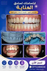 تجميل أسنان • حشوات تجميلية • الحلة