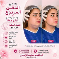 ✨ ودّعي الذقن المزدوج واستقبلي ملامح أكثر جمالاً ✨  💎 شفط الذقن المزدو...