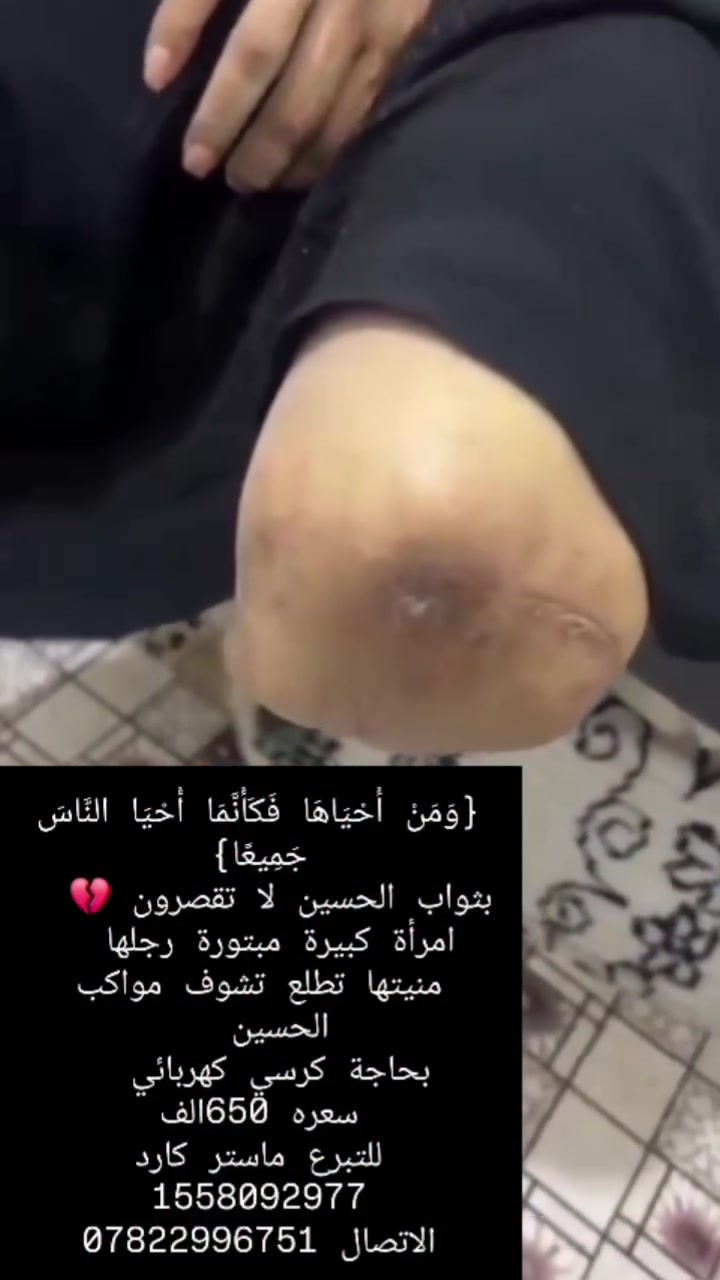 الســـلام عليـكم علی كل ابن شــریف علی شكو واحد ابن حـلال مناشدة لكل من حلیب امه طاهر
حجيه مبتوره رجلها بحاجه الى كرسي كهربائي 650الف 
الاتصال ***********
