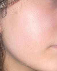 مشاكل البشرة • عناية بالبشرة • قبل العيد