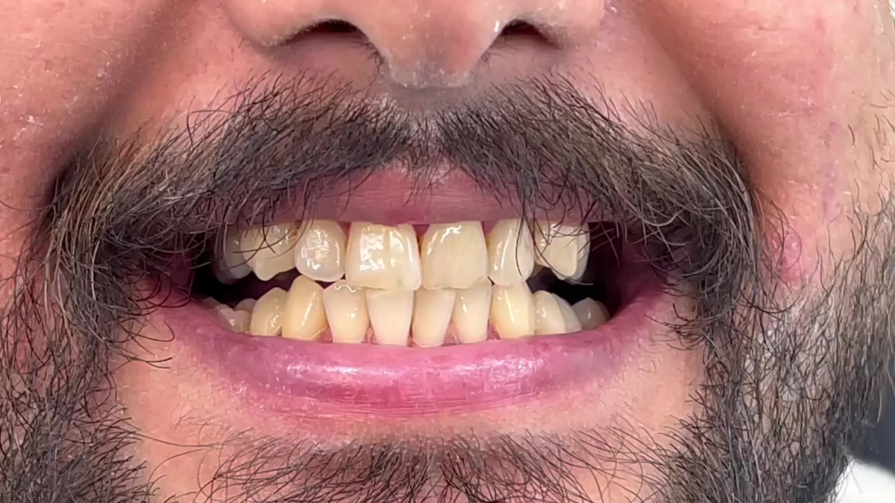 عيادة الطائي لطب الاسنان ♥️

جلسات تنظيف الاسنان راح نرجعلك عن طريقها الضحكة النظيفة الي راح تخلي ثقة بنفسك تزداد ✅

 عيادة الطائي لطب الاسنان

للحجز *********** واتس اب 
أو على الرقم *********** 

 #سبعالبور #التاجيات #التاجي #سبع_البور
