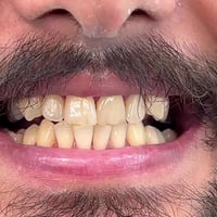 عيادة الطائي • تنظيف اسنان • سبع البور