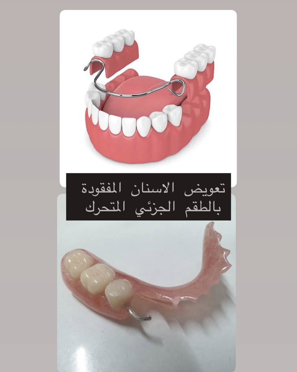 تبحث عن علاج مجاني وآمن؟✨
نلتقيكم في عياداتنا!
📅 بدأنا نستقبل الحالات في عيادات جامعة كركوك !

🔹 الخدمات المتوفرة:
 •قلع الأسنان
 •الحشوات
 •تنظيف الأسنان
 •أطقم الأسنان

سارعوا بالحجز، الحجوزات محدودة !

💌 للحجز والتفاصيل: مراسلة الصفحة او التواصل على الرقم ***********
