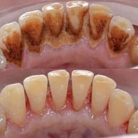 تنظيف اسنان • ازالة تكلسات • النجف